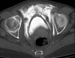 Ruptured Bladder